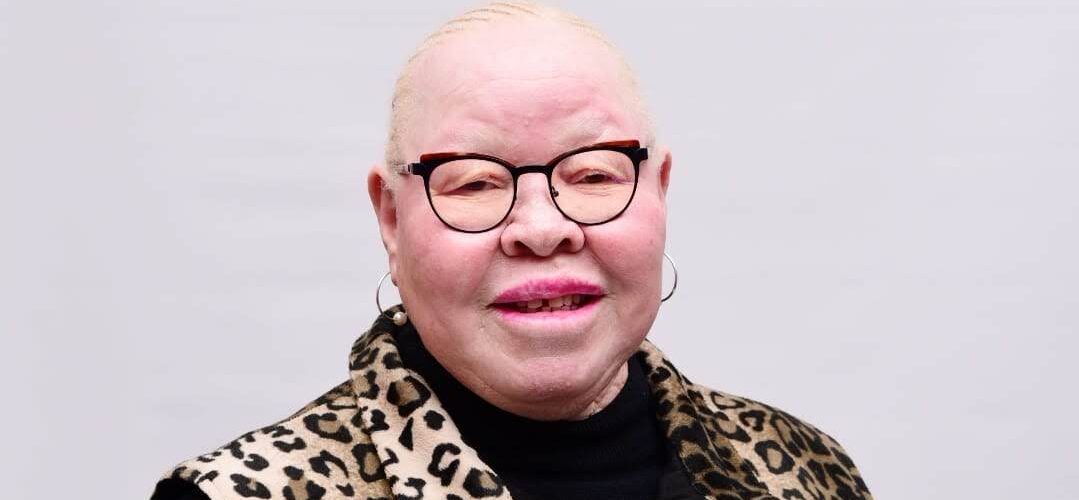 Living with albinism