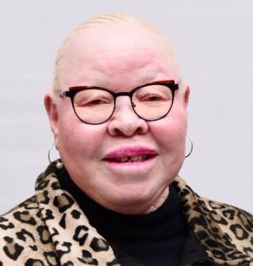 Living with albinism